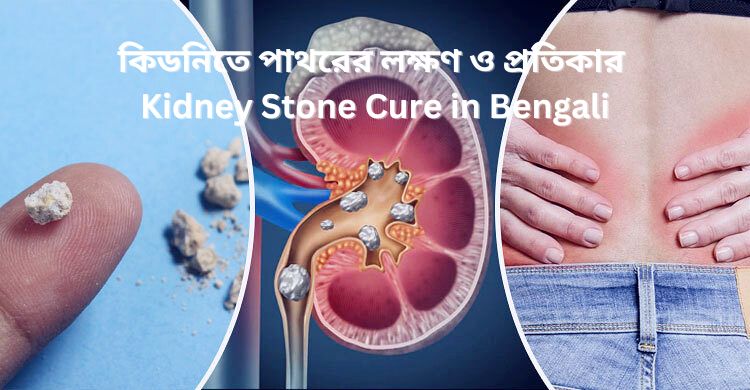 কিডনিতে পাথরের লক্ষণ ও প্রতিকার | Kidney Stone Cure in Bengali